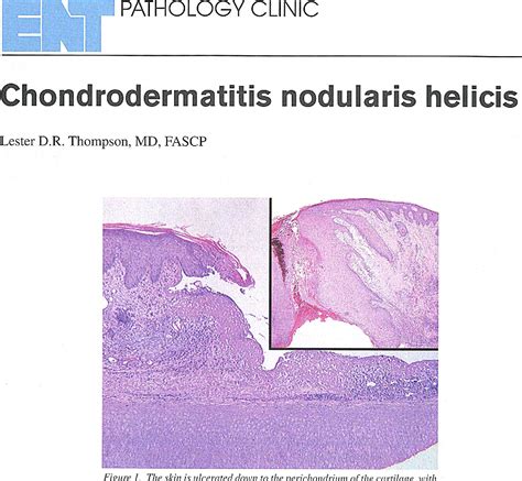 Figure 1 from Chondrodermatitis Nodularis Helicis | Semantic Scholar