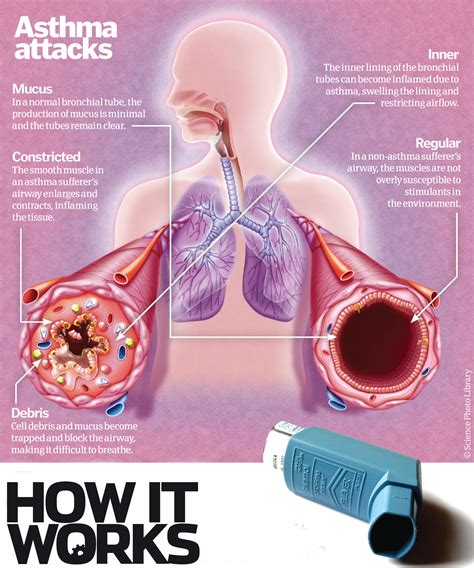 Why does asthma make it difficult to breathe? | How It Works Magazine