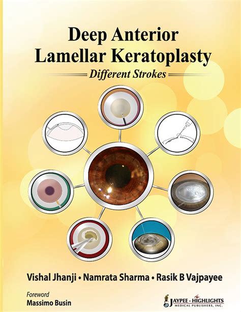 Deep Anterior Lamellar Keratoplasty: Different Strokes eBook : Jhanji ...