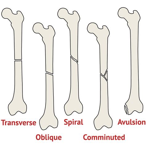 Fracture Different Types