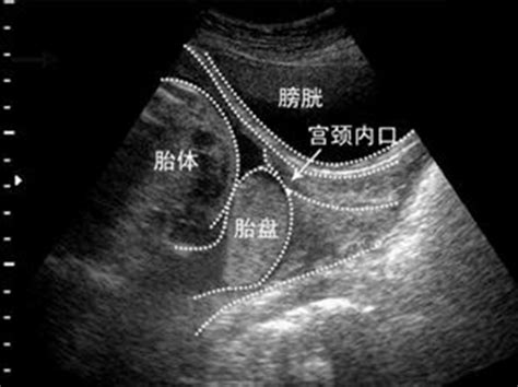 怀孕24周胎儿停育，B超显示胎宝处于中央性前置胎盘，孕妈要重视|前置胎盘|胎盘|胎儿_新浪新闻
