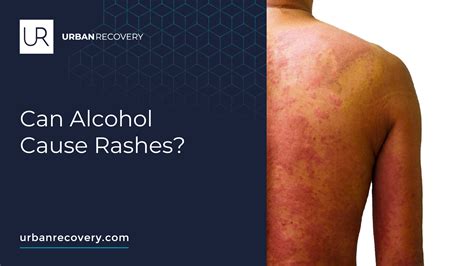 Alcohol Poisoning Rash