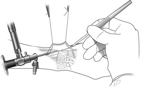 First Extensor Compartment Release Surgery at Matthew Blackburn blog