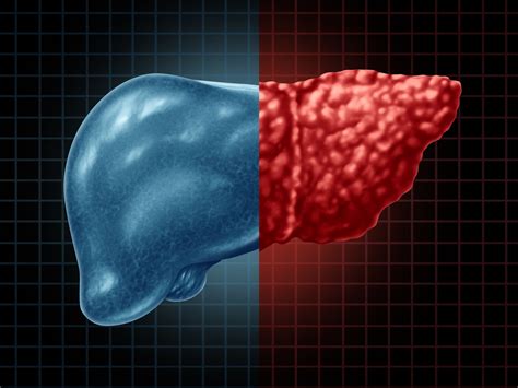 The dangers of NAFLD and how to protect yourself - Easy Health Options®