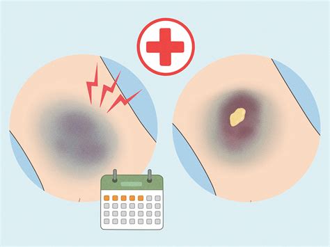 How Can You Help Heal A Bruise at Ella Byatt blog