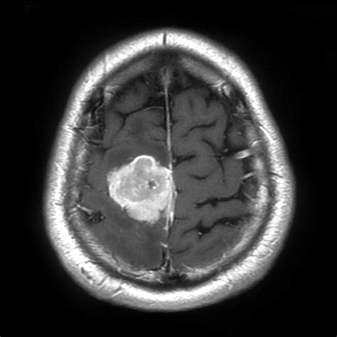 Brain Tumor MRI Images 44 Classes | Kaggle