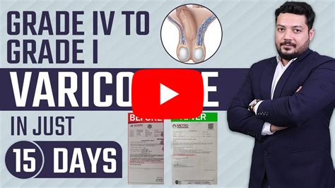 Varicocele Treatment without surgery - Dr. Health