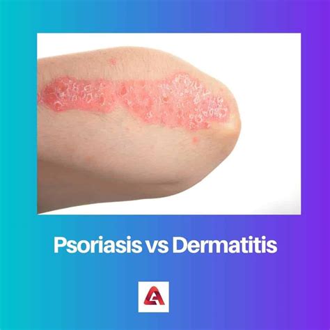 Psoriasis vs Dermatitis: Difference and Comparison