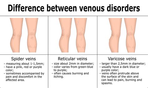 Treating Spider Veins vs Treating Varicose Veins - Expert Ideas