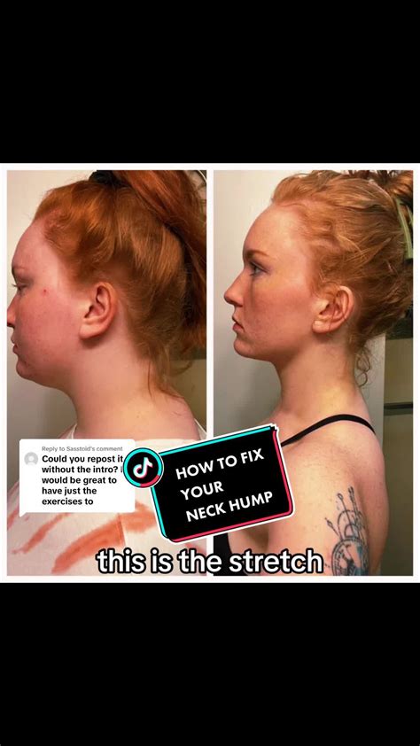 Dowager’s hump 101 7 neck hump exercises that help – Artofit