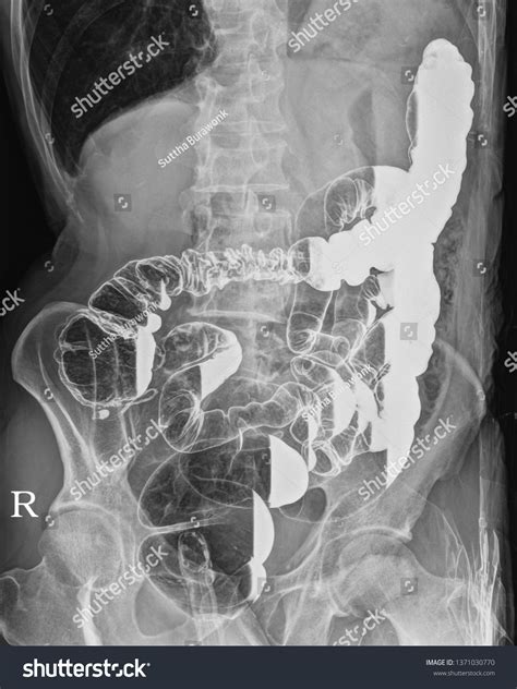 9 Right lateral decubitus Images, Stock Photos & Vectors | Shutterstock