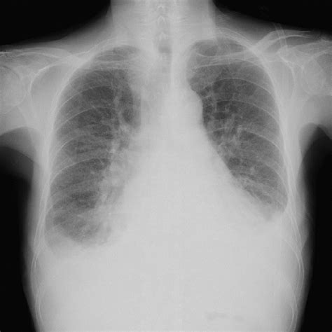 Hospital X-ray Chest 的图像结果