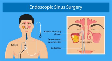 Treatment Options Las Vegas NV - Sinus Treatment Las Vegas