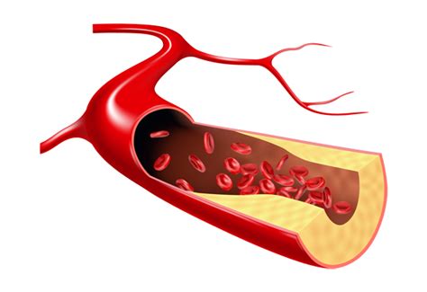 Hyperlipidemia | Loving Care Clinic