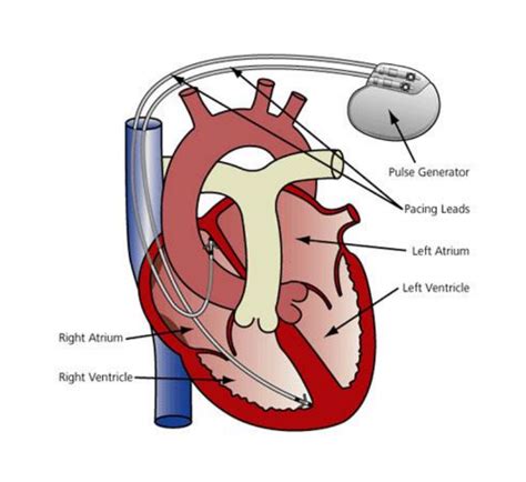 Pacemaker Procedure 的图像结果