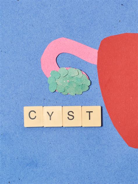 Ruptured Ovarian Cyst Removal & Surgery | O&G Specialist Clinic