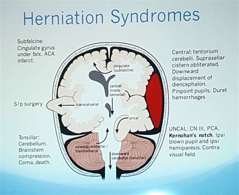 Uncal Herniation Brain Herniation Syndrome Uncal Herniation Syndromes