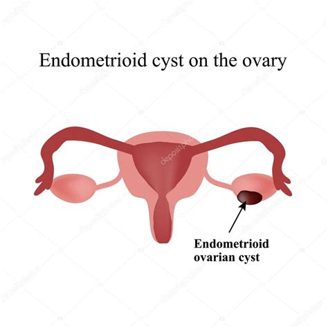 Quiste endometrioide en el ovario. Endometriosis. Ovario. Infografías ...