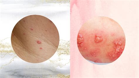 Monkeypox: Telangana's first sample negative but another suspected case ...