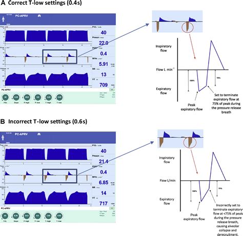 Airway pressure release ventilation - BJA Education