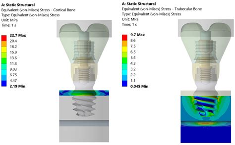 Loading Pressure Induced by 4 mm Implants on the Inferior Alveolar ...