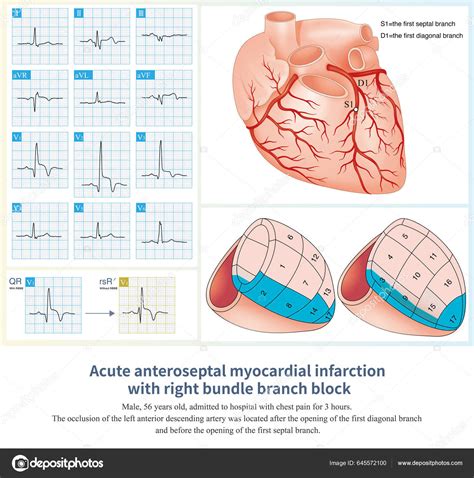 Acute Anteroseptal Myocardial Infarction Combined Right Bundle Branch Block Qrs Stock Photo by ...