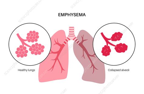 Image result for Emphysema Example