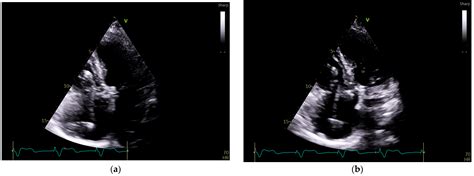 Wide Complex Irregular Rhythm in a Paced Patient: A Clinical Approach