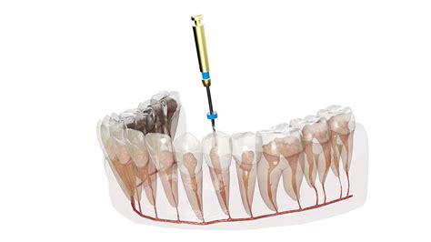 Comfortable Root Canal Treatment in Rajinder Nagar, Delhi