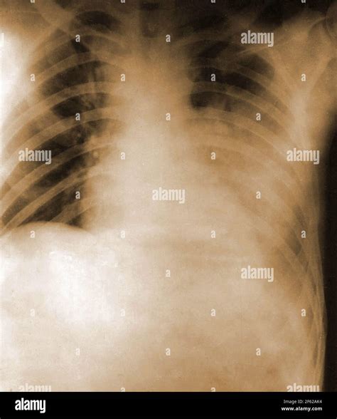 Spanish Flu, Chest X-Ray, 1918 Stock Photo - Alamy