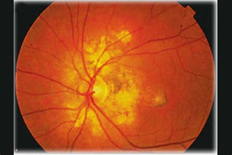 Get Well Soon: Very high prevalence of ocular tuberculosis in the country