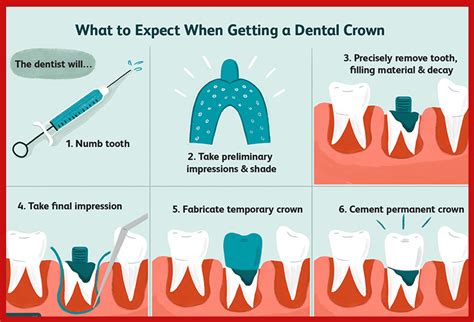 Dental Crown: Types, Procedure and Cost - Saigon Implant Dental Clinic ...