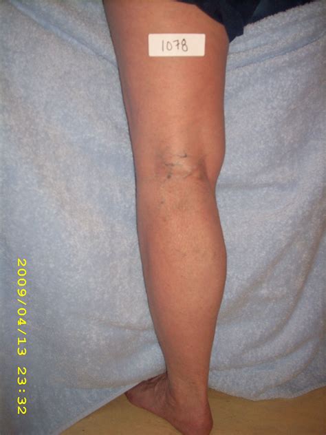 Varicose veins behind the knee. They are not always enlarged and bulging, but they are usually ...