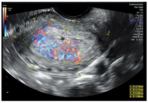 Endometrial Cancer Ultrasound
