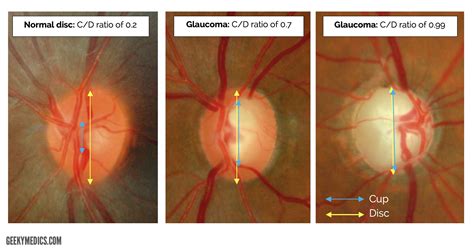 Fundoscopic Appearances of Retinal Pathologies | Geeky Medics