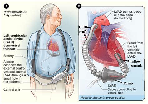Longest Surviving Lvad Patient