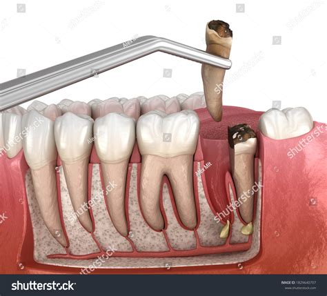 Image result for What Is a Complex Tooth Extraction