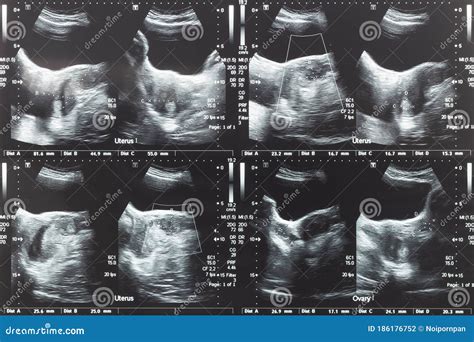 Ultrasound Image of Lower Abdomen, Ovary and Uterus with Tumor or ...