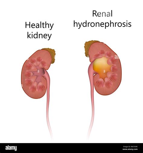 Renal hydronephrosis, comparison with healthy kidney, illustration. The ...