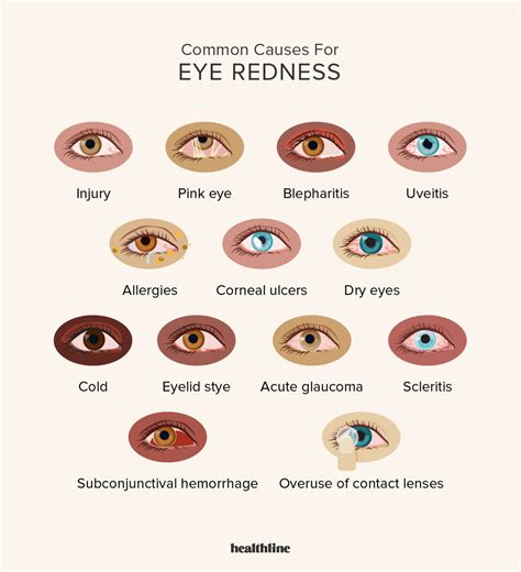 Red eyes 20 causes symptoms complications and more – Artofit