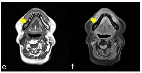 Clinical Diagnostic Imaging Study of Osteoradionecrosis of the Jaw: A Retrospective Study