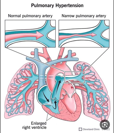 COPD Chronic Obstructive Pulmonary Disease تنقسم لنوعين أساسيين وهم ...