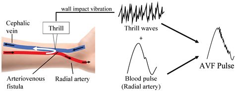 Dialysis Fistula Ultrasound