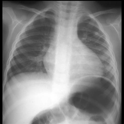 right aortic arch with aberrant left subclavian artery | pacs