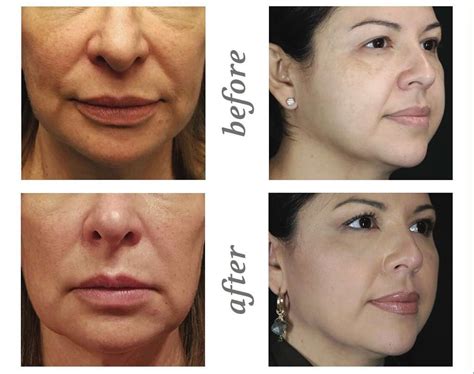 How Does Threading Face Lift Works 的图像结果