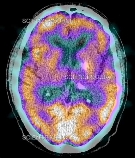 Image result for SPECT Scan Brain Prefrontal Cortex