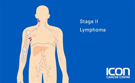 What is Lymphoma? Lymphoma Explained | Icon Cancer Centre Malaysia