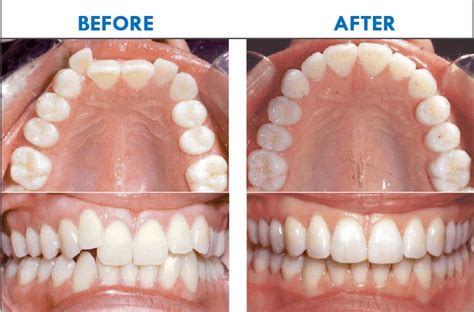 Invisalign in Gurgaon | Invisible Braces Treatment Cost in Gurgaon