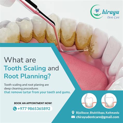 Price Of Scaling Teeth In Nepal at Katrina Bates blog