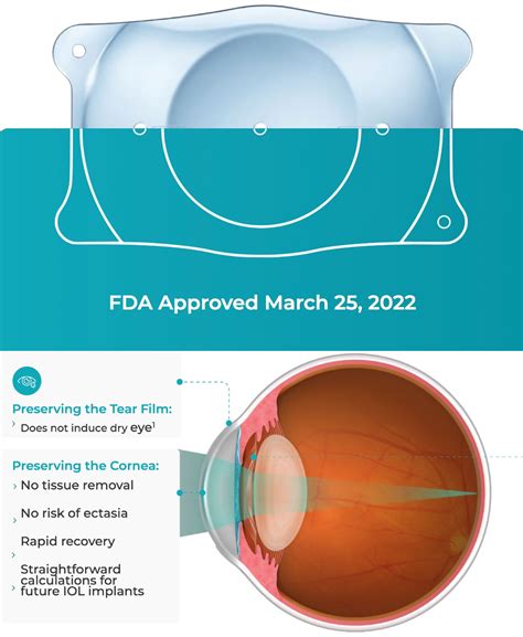 FAQ EVO ICL (Implantable Collamer Lens), LASIK Surgery